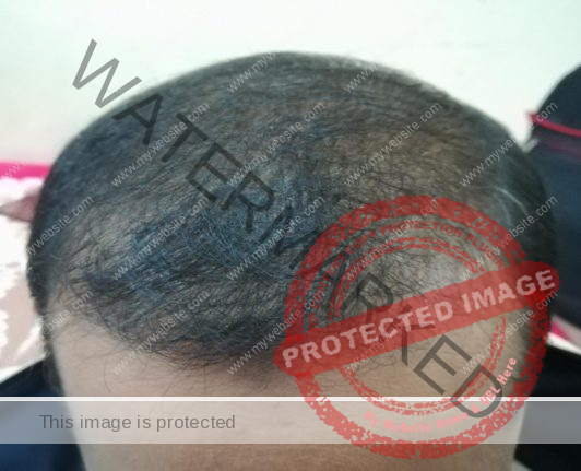 D:\hair transplant pt\imran after 6 months\IMG-20171210-WA0005.jpg