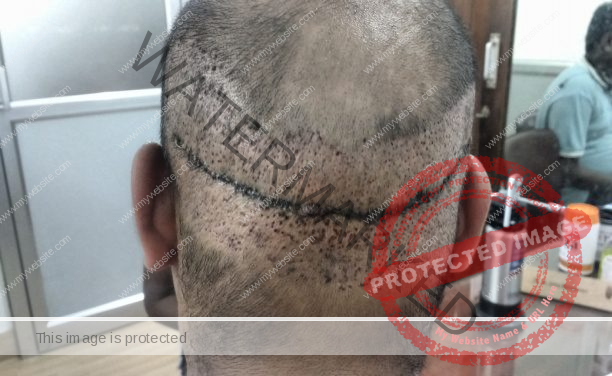 D:\hair transplant pt\imran after surgery\IMG_20170916_141751117.jpg