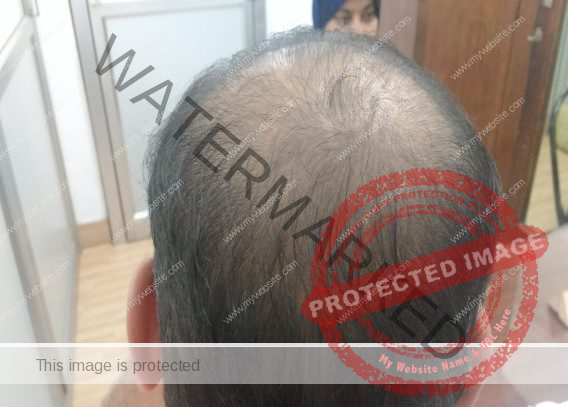 D:\hair transplant pt\imran before\IMG_20170825_194920886.jpg