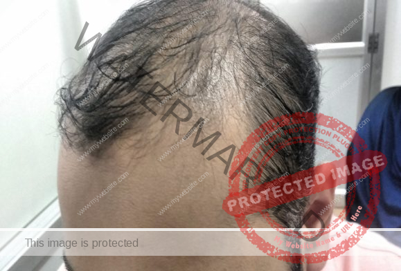 D:\hair transplant pt\imran before\IMG_20170825_194945843.jpg