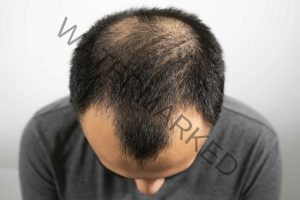 hair loss treatment in chennai