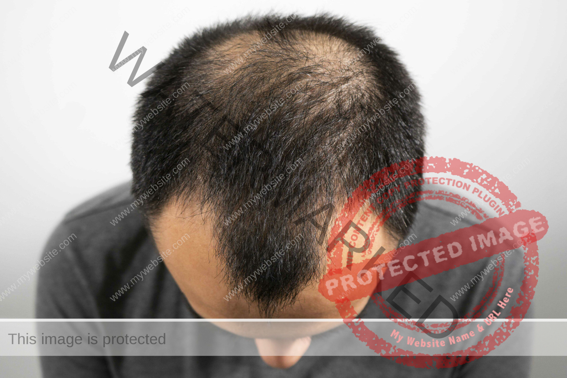 hair loss treatment in chennai